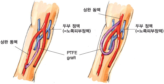 인조혈관을 이용한 동정맥루